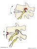 Foraminal Stenosis of the Spine | Illustration of Stenosis | Back Pain | Spine Surgeon Near Denver, Colorado