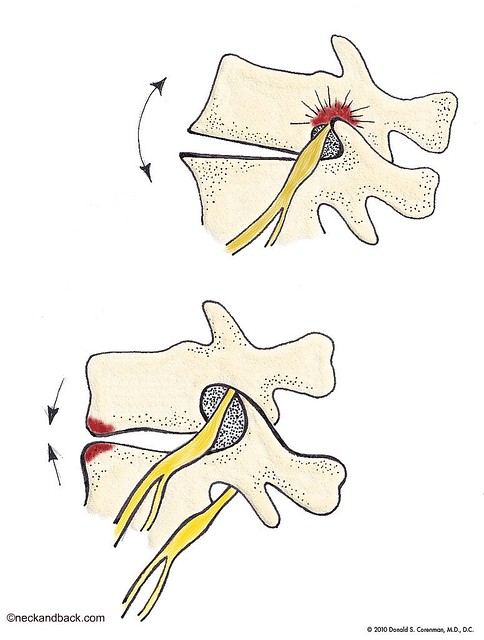 Foraminal Stenosis of the Spine | Illustration of Stenosis | Back Pain | Spine Surgeon Near Denver, Colorado