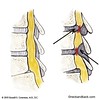 Stenosis of the Spine | Illustration of SPINAL STENOSIS | Spine Doctor in Vail, Colorado