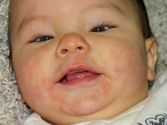 Baby Eczema