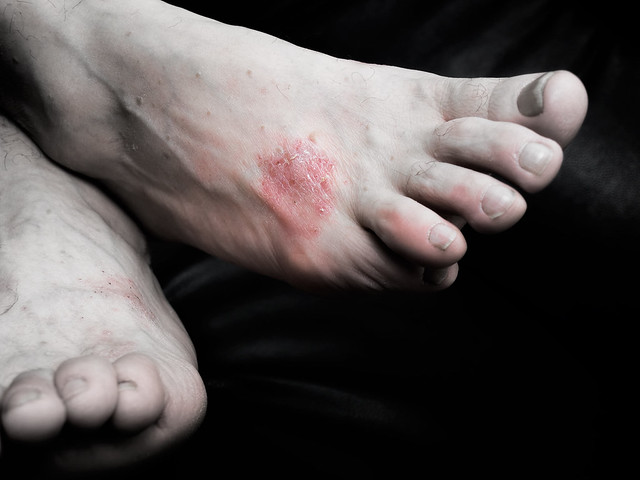 Psoriasis on foot