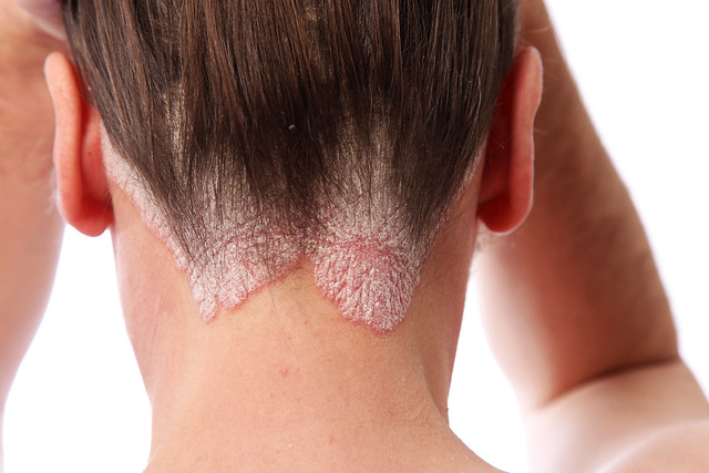 Psoriasis on back of neck