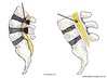 Illustration of SPINAL STENOSIS | Central Stenosis of the Spine | Colorado Spine Doctor