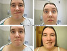 BELLS PALSY Expression Montage