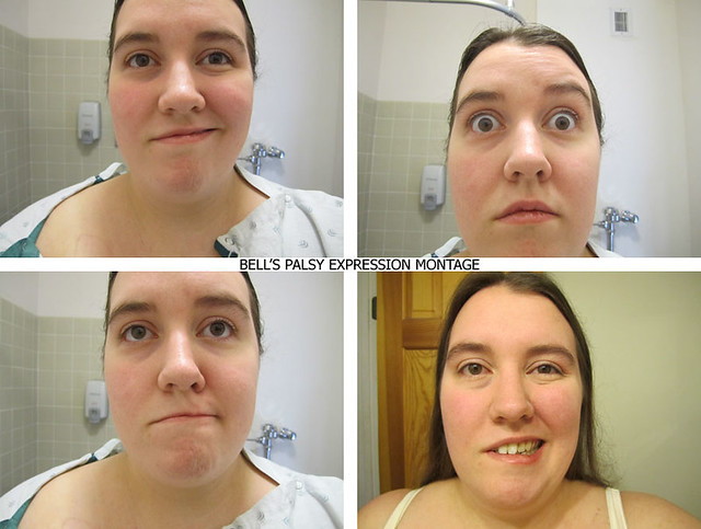 BELLS PALSY Expression Montage