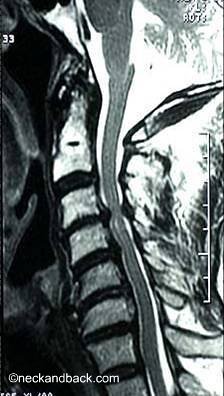 Cervical Central Stenosis | Image of Stenosis of the Spine | Spine Specialist in Vail, Colorado