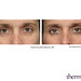 Thermage Eyes makes eyes seem instantly more open and alert.