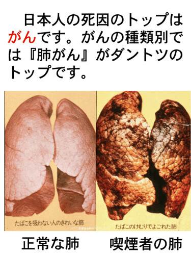 肺癌の原因は喫煙です。喫煙で肺がんの闘病...
