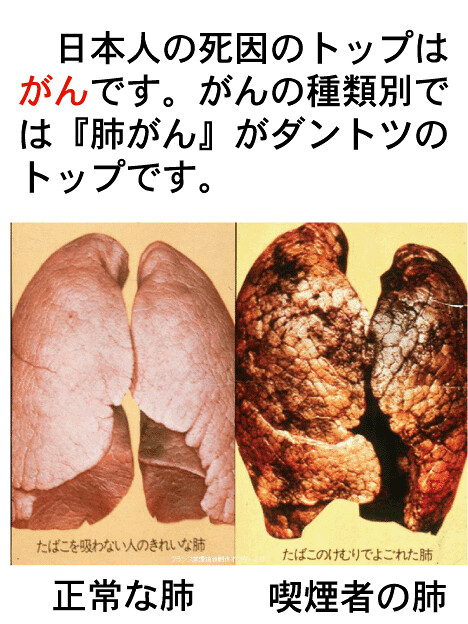肺癌の原因は喫煙です。喫煙で肺がんの闘病...
