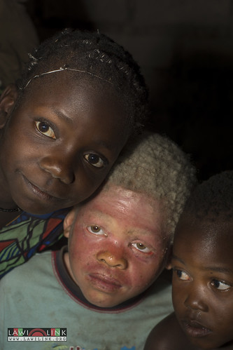 Persons with Albinism • <a style="font-size:0.8em;" href="http://www.flickr.com/photos/132148455@N06/26636489394/" target="_blank">View on Flickr</a>