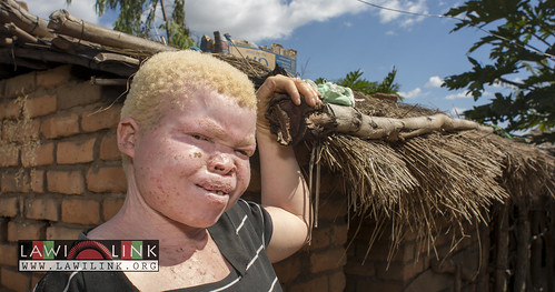 Persons with Albinism • <a style="font-size:0.8em;" href="http://www.flickr.com/photos/132148455@N06/26637315653/" target="_blank">View on Flickr</a>
