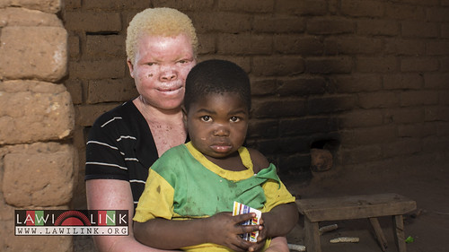 Persons with Albinism • <a style="font-size:0.8em;" href="http://www.flickr.com/photos/132148455@N06/27242977335/" target="_blank">View on Flickr</a>