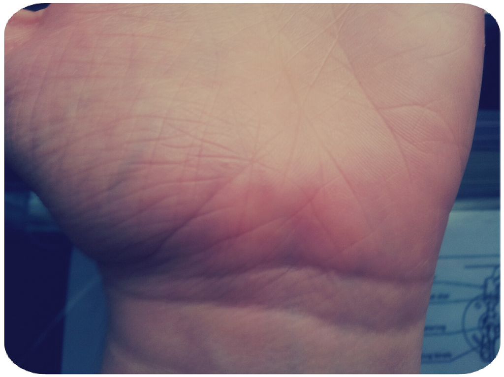 bumps under skin palm hand - MedHelp