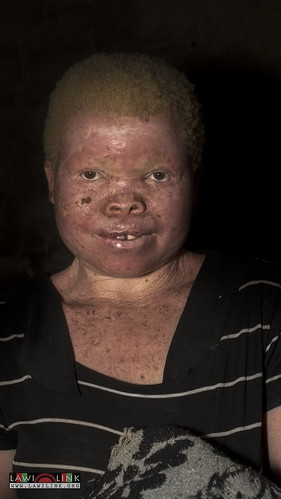 Persons with Albinism • <a style="font-size:0.8em;" href="http://www.flickr.com/photos/132148455@N06/27242984735/" target="_blank">View on Flickr</a>