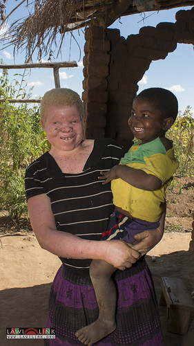 Persons with Albinism • <a style="font-size:0.8em;" href="http://www.flickr.com/photos/132148455@N06/27208818536/" target="_blank">View on Flickr</a>