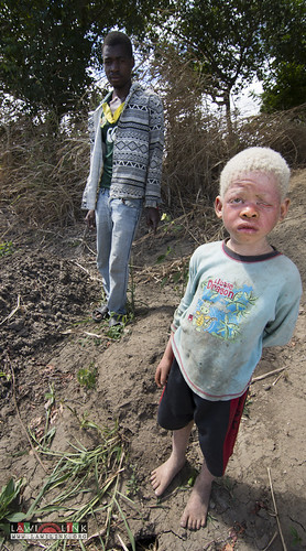 Persons with Albinism • <a style="font-size:0.8em;" href="http://www.flickr.com/photos/132148455@N06/26967797980/" target="_blank">View on Flickr</a>