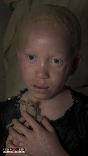 Persons with Albinism • <a style="font-size:0.8em;" href="http://www.flickr.com/photos/132148455@N06/26968696910/" target="_blank">View on Flickr</a>