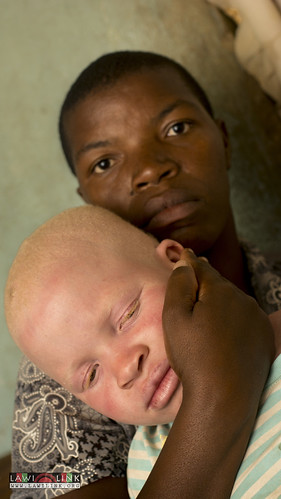 Persons with Albinism • <a style="font-size:0.8em;" href="http://www.flickr.com/photos/132148455@N06/27173574371/" target="_blank">View on Flickr</a>