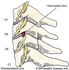 Cervical Herniated Nucleus Pulposus | Image of...