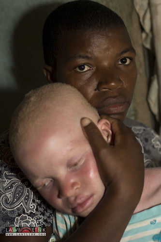Persons with Albinism • <a style="font-size:0.8em;" href="http://www.flickr.com/photos/132148455@N06/27208589806/" target="_blank">View on Flickr</a>