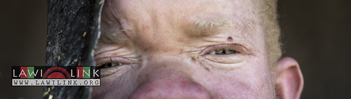 Persons with Albinism • <a style="font-size:0.8em;" href="http://www.flickr.com/photos/132148455@N06/26969021950/" target="_blank">View on Flickr</a>