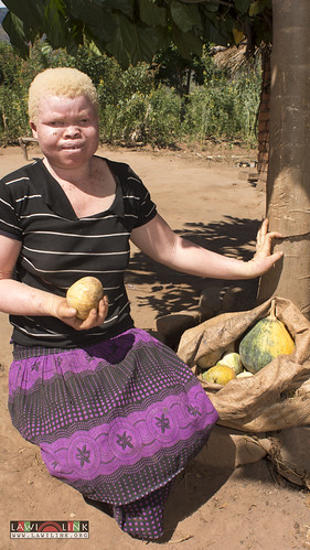 Persons with Albinism • <a style="font-size:0.8em;" href="http://www.flickr.com/photos/132148455@N06/27145897842/" target="_blank">View on Flickr</a>