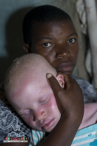 Persons with Albinism • <a style="font-size:0.8em;" href="http://www.flickr.com/photos/132148455@N06/27173579381/" target="_blank">View on Flickr</a>