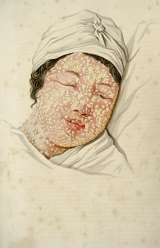 variola, or smallpox