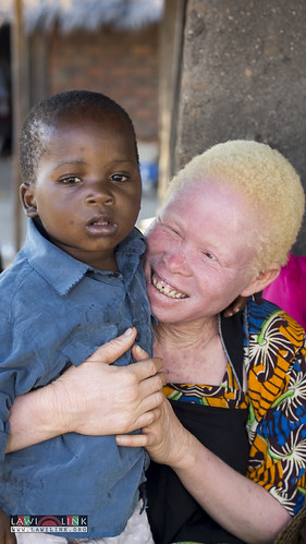 Persons with Albinism • <a style="font-size:0.8em;" href="http://www.flickr.com/photos/132148455@N06/27209525976/" target="_blank">View on Flickr</a>