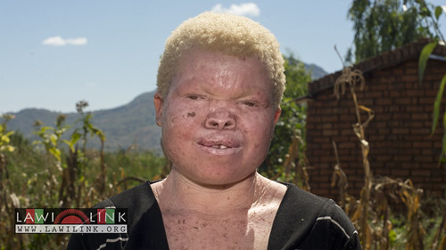 Persons with Albinism • <a style="font-size:0.8em;" href="http://www.flickr.com/photos/132148455@N06/27145995932/" target="_blank">View on Flickr</a>