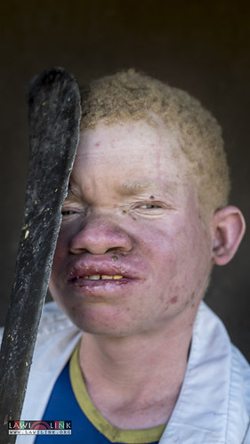 Persons with Albinism • <a style="font-size:0.8em;" href="http://www.flickr.com/photos/132148455@N06/27147308682/" target="_blank">View on Flickr</a>