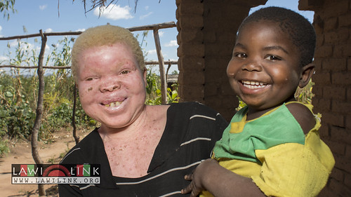 Persons with Albinism • <a style="font-size:0.8em;" href="http://www.flickr.com/photos/132148455@N06/26967638120/" target="_blank">View on Flickr</a>