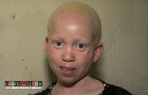 Persons with Albinism • <a style="font-size:0.8em;" href="http://www.flickr.com/photos/132148455@N06/26637068854/" target="_blank">View on Flickr</a>