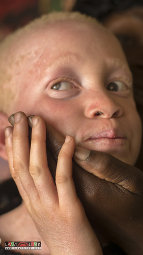 Persons with Albinism • <a style="font-size:0.8em;" href="http://www.flickr.com/photos/132148455@N06/27174702111/" target="_blank">View on Flickr</a>