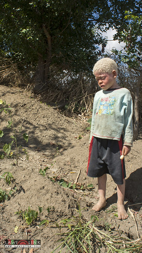 Persons with Albinism • <a style="font-size:0.8em;" href="http://www.flickr.com/photos/132148455@N06/27243188865/" target="_blank">View on Flickr</a>