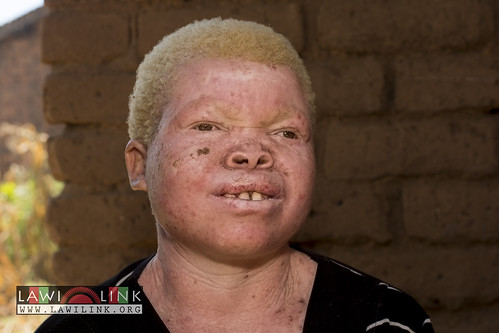Persons with Albinism • <a style="font-size:0.8em;" href="http://www.flickr.com/photos/132148455@N06/26967688050/" target="_blank">View on Flickr</a>