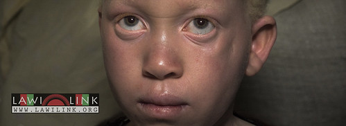 Persons with Albinism • <a style="font-size:0.8em;" href="http://www.flickr.com/photos/132148455@N06/27244055345/" target="_blank">View on Flickr</a>