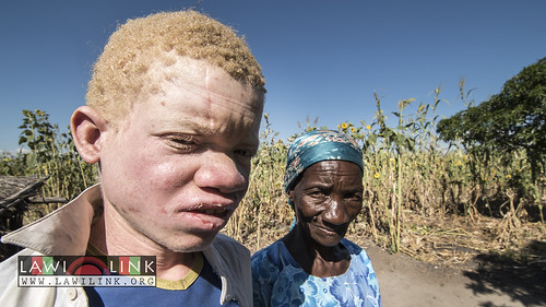Persons with Albinism • <a style="font-size:0.8em;" href="http://www.flickr.com/photos/132148455@N06/27210424196/" target="_blank">View on Flickr</a>