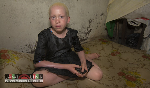Persons with Albinism • <a style="font-size:0.8em;" href="http://www.flickr.com/photos/132148455@N06/27244097355/" target="_blank">View on Flickr</a>