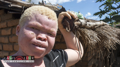 Persons with Albinism • <a style="font-size:0.8em;" href="http://www.flickr.com/photos/132148455@N06/27145878172/" target="_blank">View on Flickr</a>