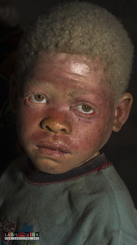Persons with Albinism • <a style="font-size:0.8em;" href="http://www.flickr.com/photos/132148455@N06/27209211556/" target="_blank">View on Flickr</a>