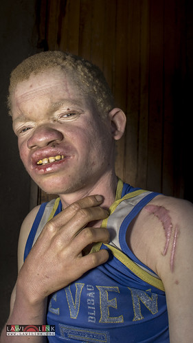 Persons with Albinism • <a style="font-size:0.8em;" href="http://www.flickr.com/photos/132148455@N06/27210059346/" target="_blank">View on Flickr</a>