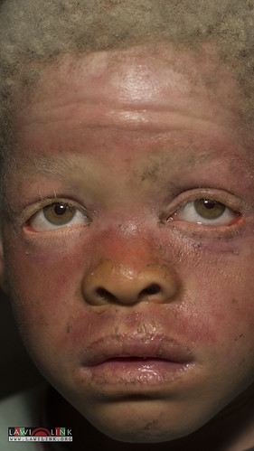 Persons with Albinism • <a style="font-size:0.8em;" href="http://www.flickr.com/photos/132148455@N06/27243328365/" target="_blank">View on Flickr</a>