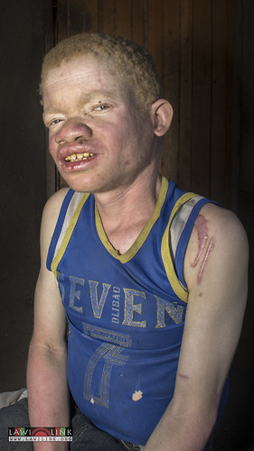 Persons with Albinism • <a style="font-size:0.8em;" href="http://www.flickr.com/photos/132148455@N06/27244296525/" target="_blank">View on Flickr</a>