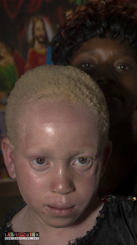 Persons with Albinism • <a style="font-size:0.8em;" href="http://www.flickr.com/photos/132148455@N06/26637041094/" target="_blank">View on Flickr</a>