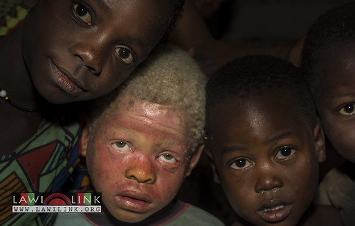 Persons with Albinism • <a style="font-size:0.8em;" href="http://www.flickr.com/photos/132148455@N06/26968047260/" target="_blank">View on Flickr</a>